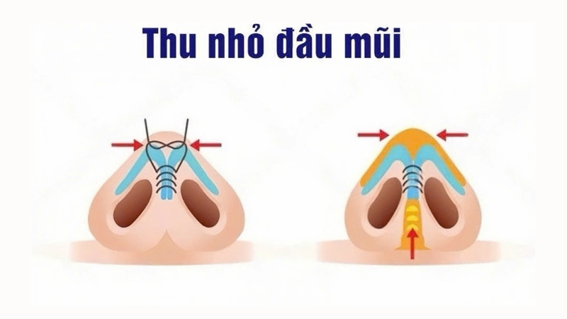 tạo hình đầu mũi