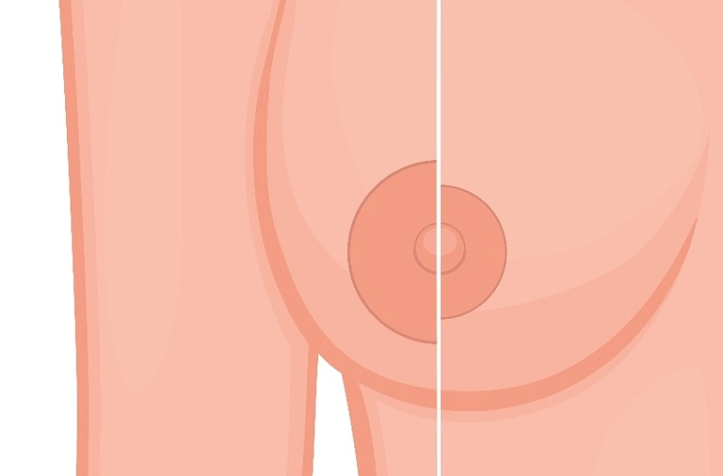 Quầng vú bị giãn rộng/phì đại có thể do bẩm sinh, thay đổi nội tiết tố hoặc sau quá trình mang thai, cho con bú...