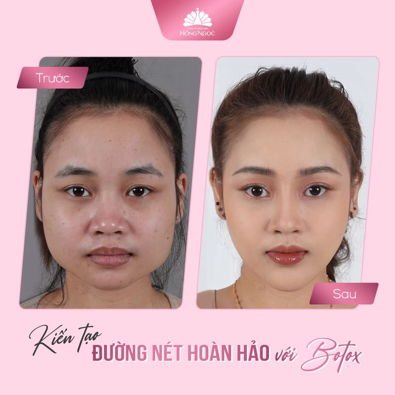 tiêm botox gọn hàm
