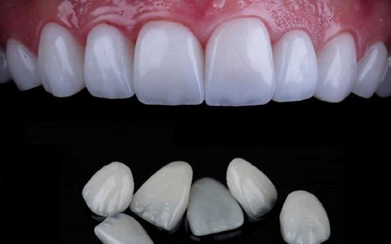 tính năng Veneer Emax