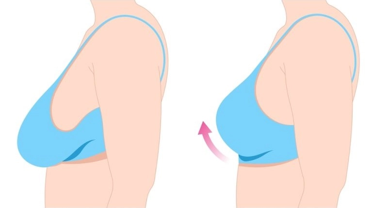 Ngực sa trễ gây ảnh hưởng tới thẩm mỹ, khiến người phụ nữ cảm thấy tự ti trong sinh hoạt và đời sống tình cảm
