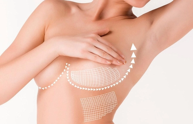 Đặc biệt phù hợp với treo sa trễ không đặt túi