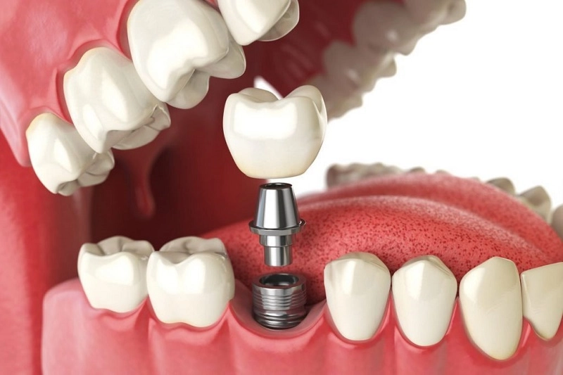 Vì sao ngày càng nhiều khách hàng lựa chọn trồng răng Implant uy tín? 
