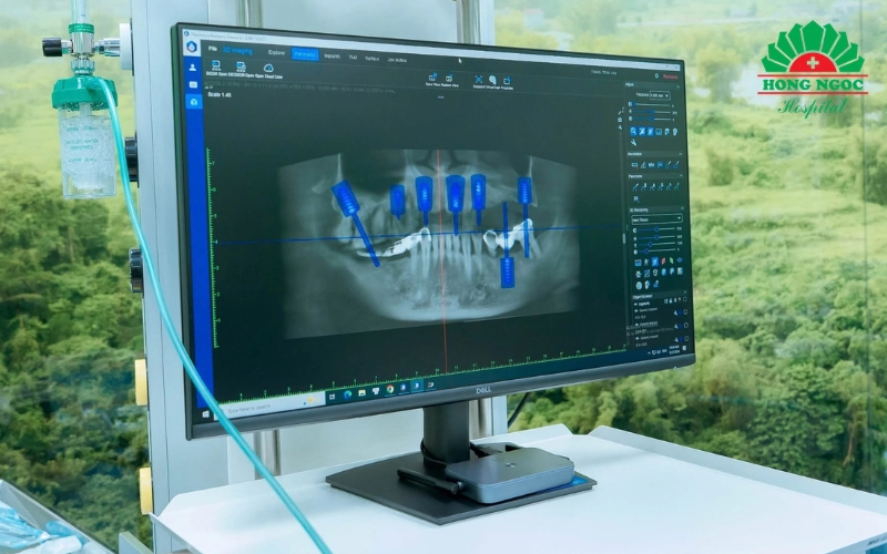 Tiến hành cấy trụ Implant
