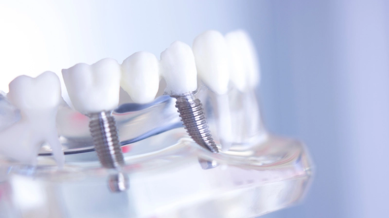 trồng răng Implant có cần nghỉ dưỡng không