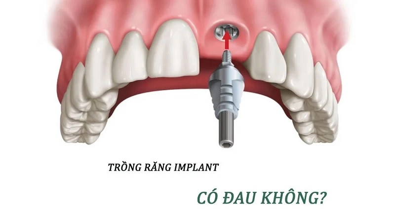 Quá trình trồng răng Implant hầu như không gây đau