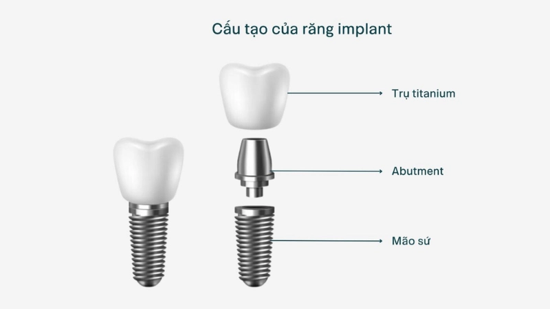 trồng răng Implant đơn lẻ