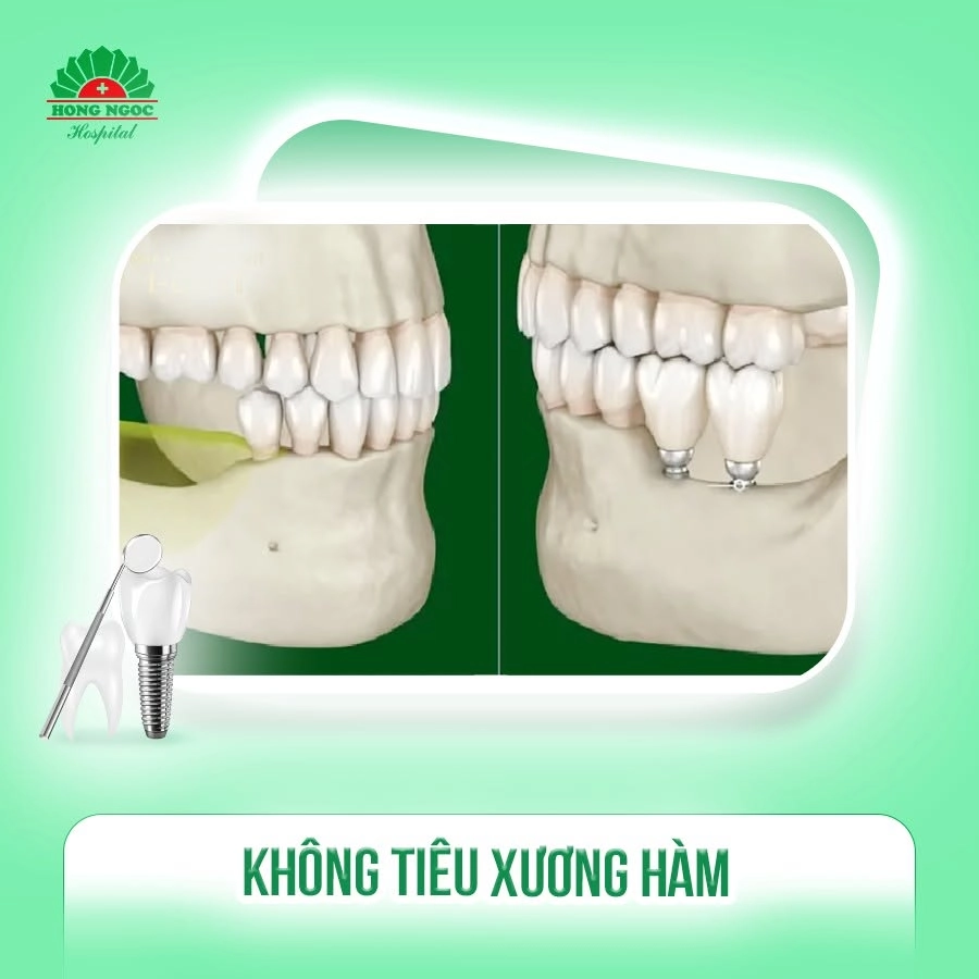 Ưu điểm nổi bật của răng Implant