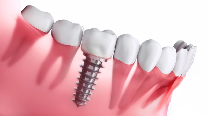 trồng răng Implant đơn lẻ
