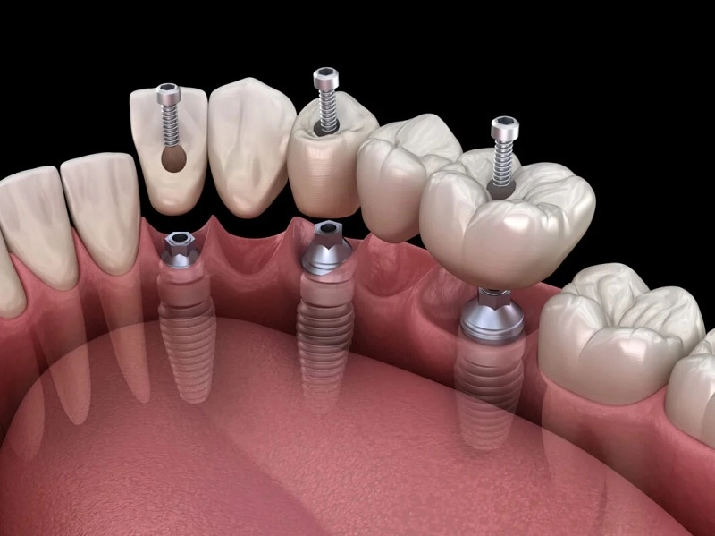 trồng răng implant là gì
