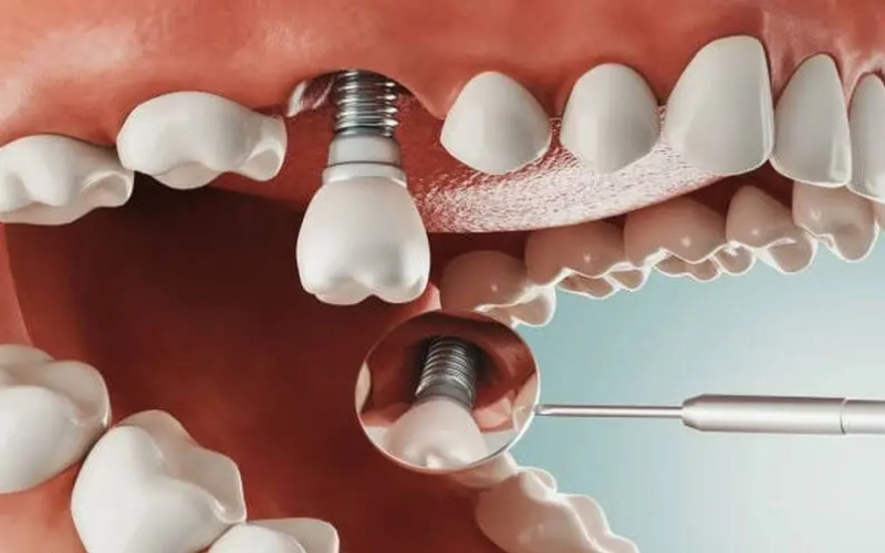  trồng răng Implant mất khoảng 3-6 tháng để hoàn tất