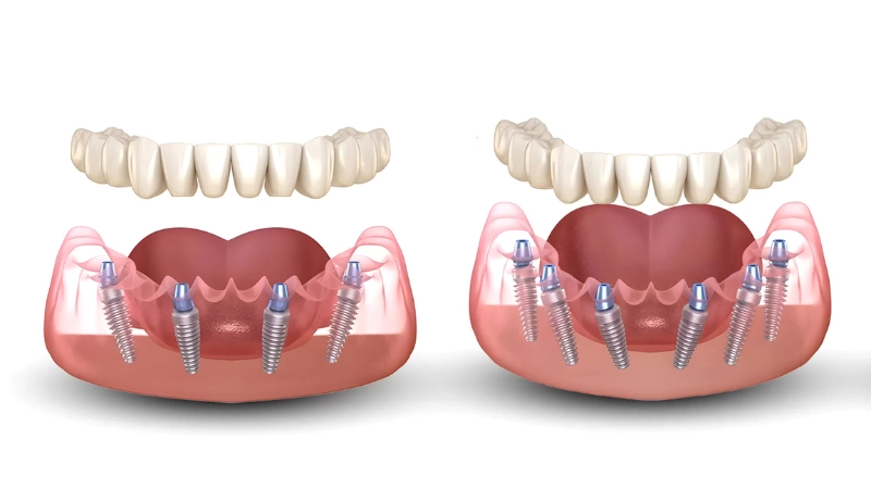 trồng răng implant toàn hàm