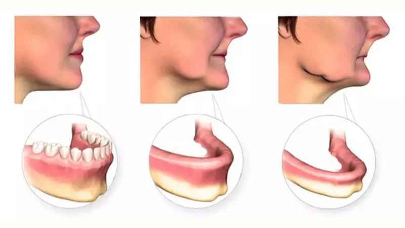 trồng răng implant toàn hàm