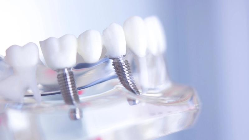 trụ Implant Thụy Sĩ