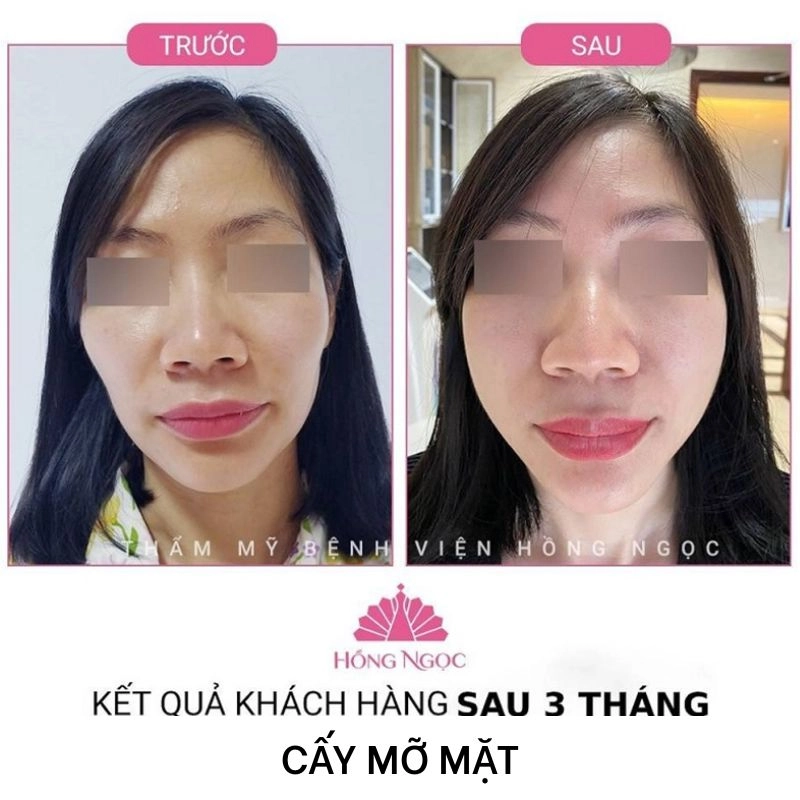 tư vấn cá nhân hóa cấy mỡ mặt