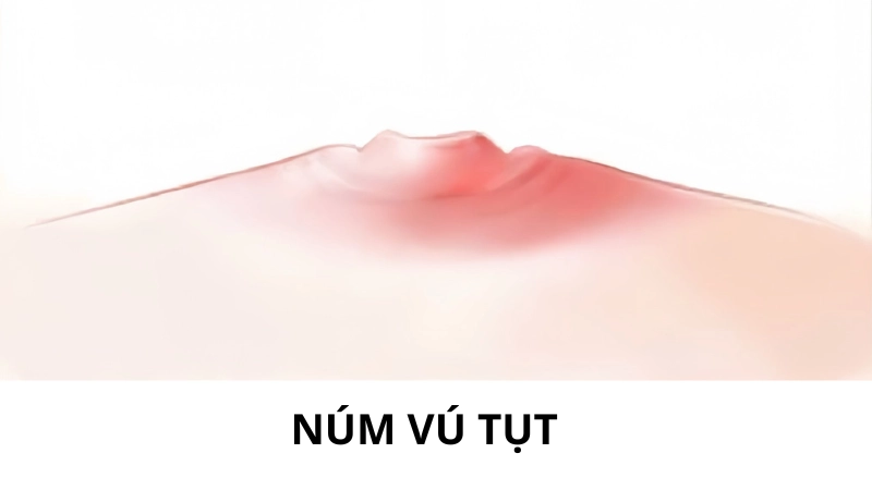 tụt núm vú
