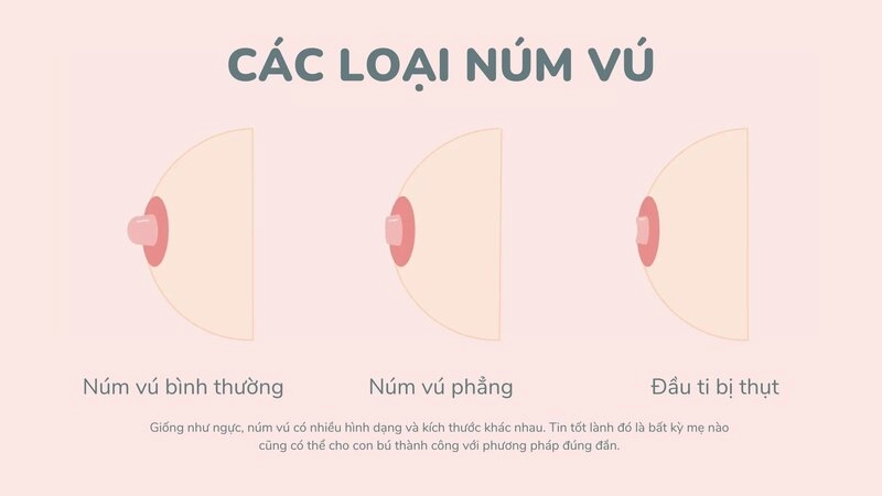 tụt núm vú