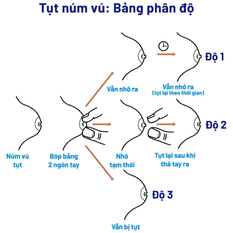 Ưu điểm của phẫu thuật núm vú tụt