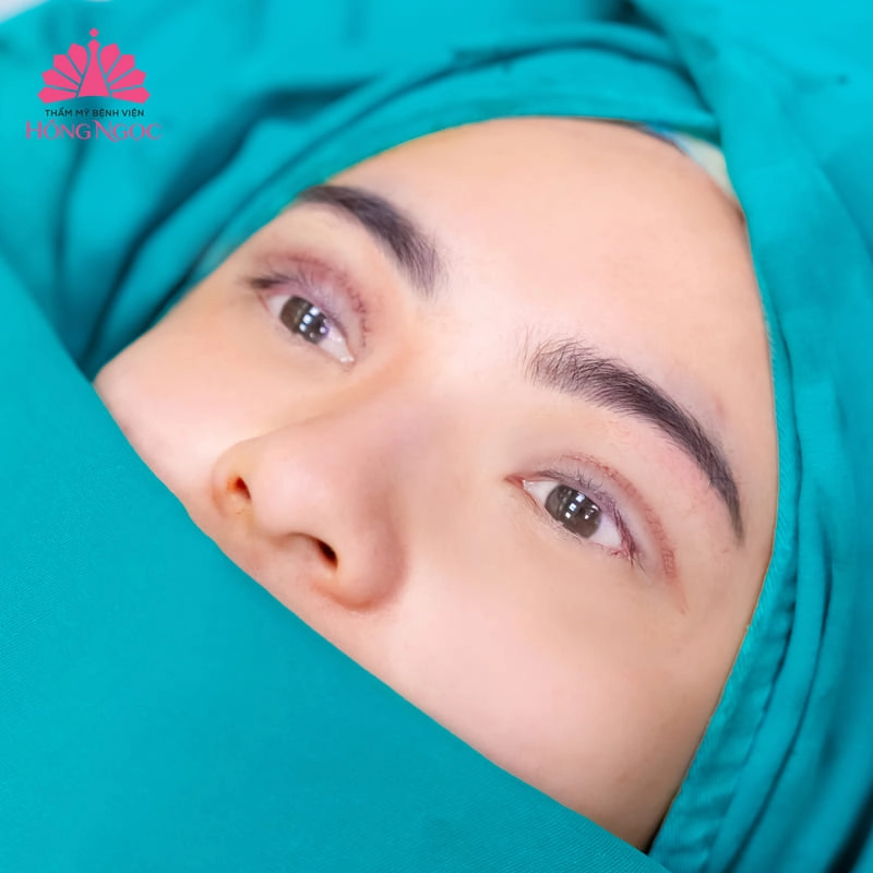 ưu điểm cắt mí mắt