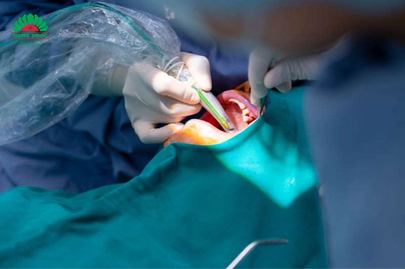 ưu điểm cấy ghép implant