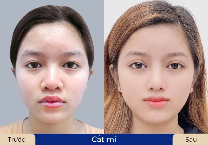 ưu điểm của cắt mí mắt