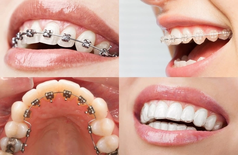 Ưu điểm nổi bật của niềng răng mắc cài kim loại  