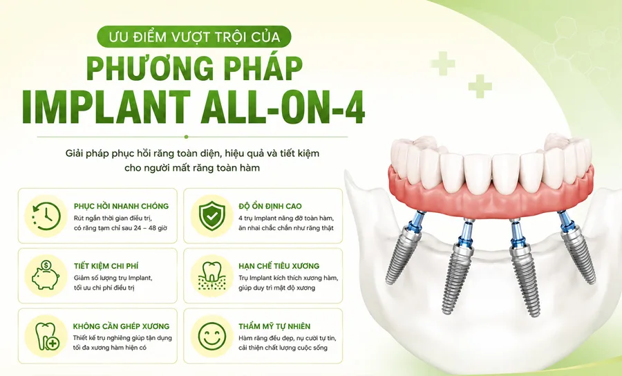 Ưu điểm vượt trội của các phương pháp trồng răng Implant toàn hàm