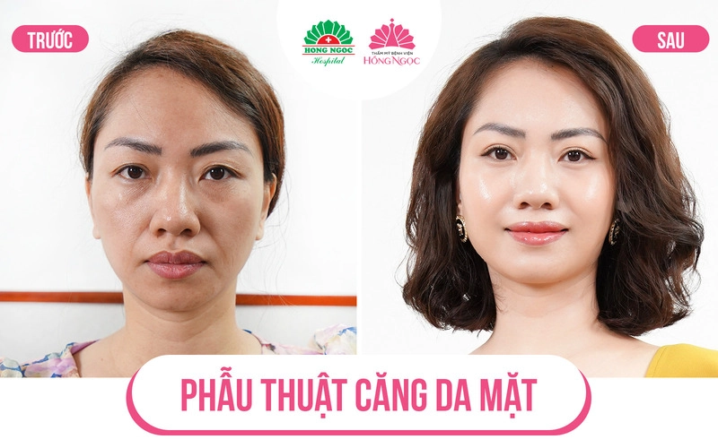 ưu điểm phẫu thuật căng da mặt