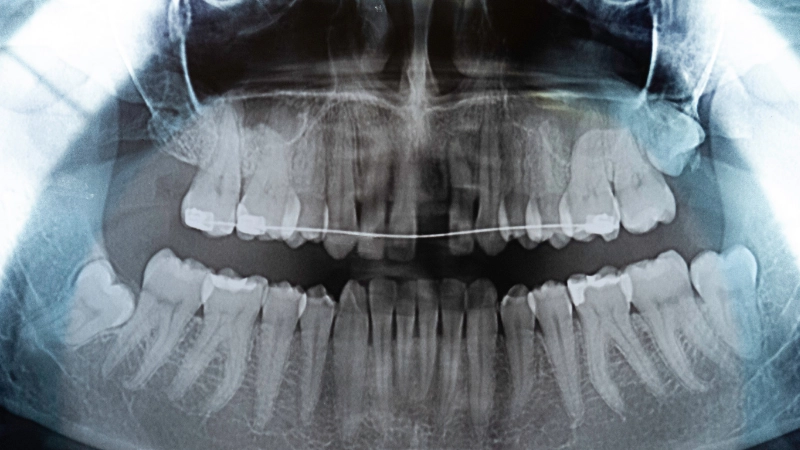 vì sao cần nhổ răng khôn trước khi niềng răng
