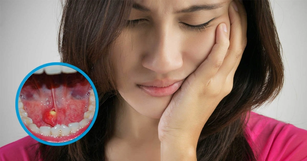 Vôi hóa tuyến nước bọt